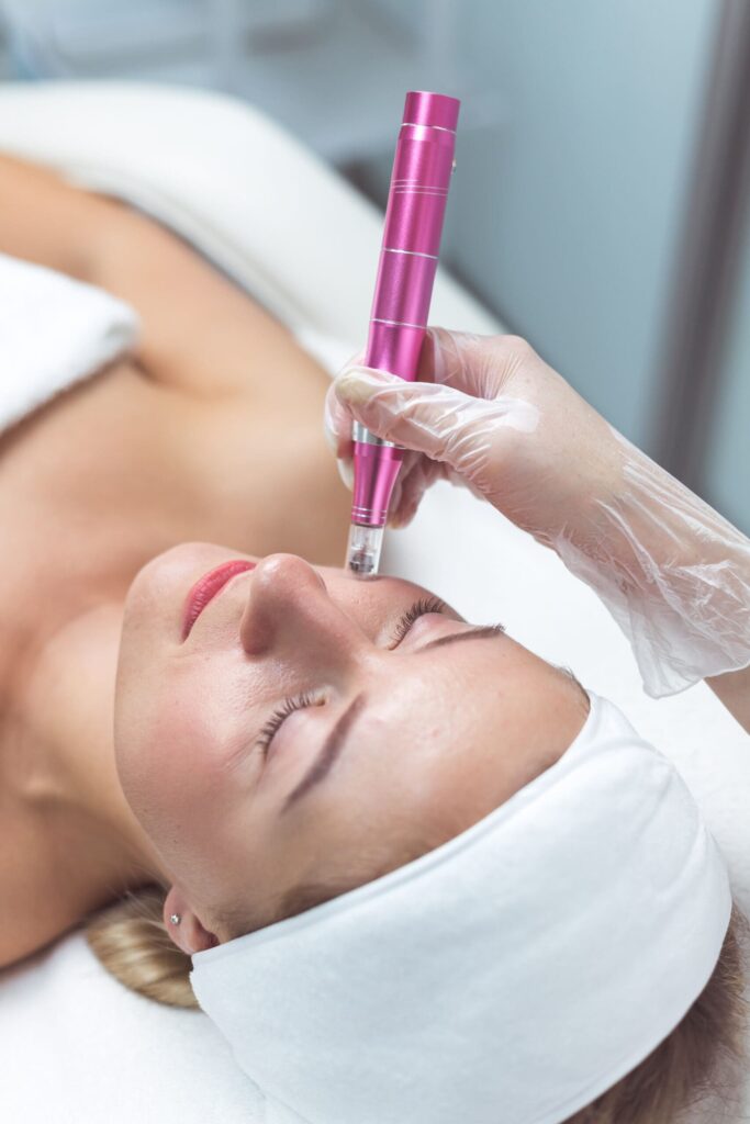 Bild zeigt eine Frau während der Microneedling in Hamburg