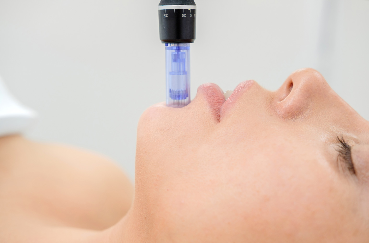 Bild zeigt ein Microneedling in Hamburg