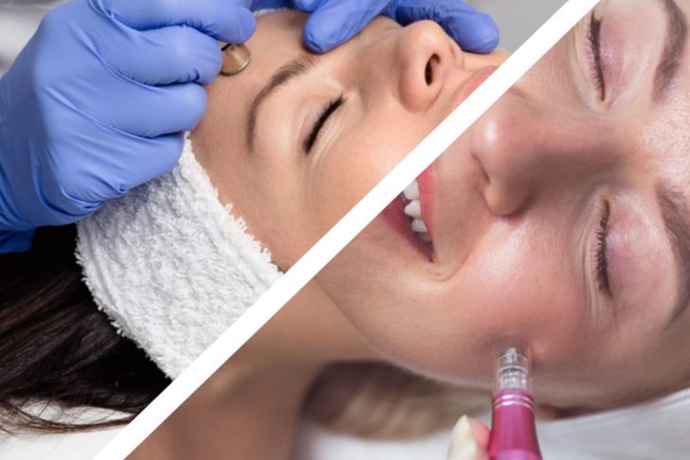 Aquafacial oder Microneedling Hamburg harburg wilstorf (1)