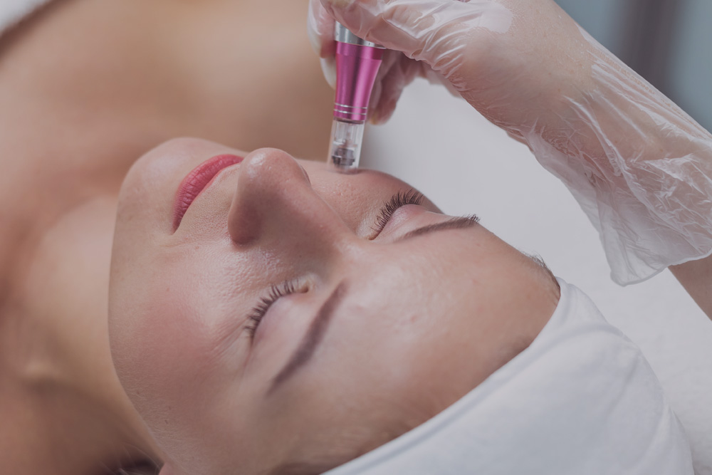 Microneedling in Hamburg Harburg Seevetal Wilstorf Gesichtsbehandlung Kosmetikstudio